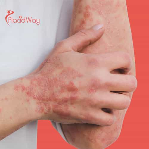 Psoriasis Doesn’t Have to Win: Why Americans Are Turning to Immune-Level Strategies in Mexico for Skin Balance